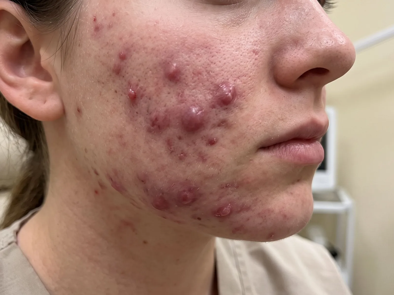 Acnee nodulară și cicatrici: când mergi la dermatolog