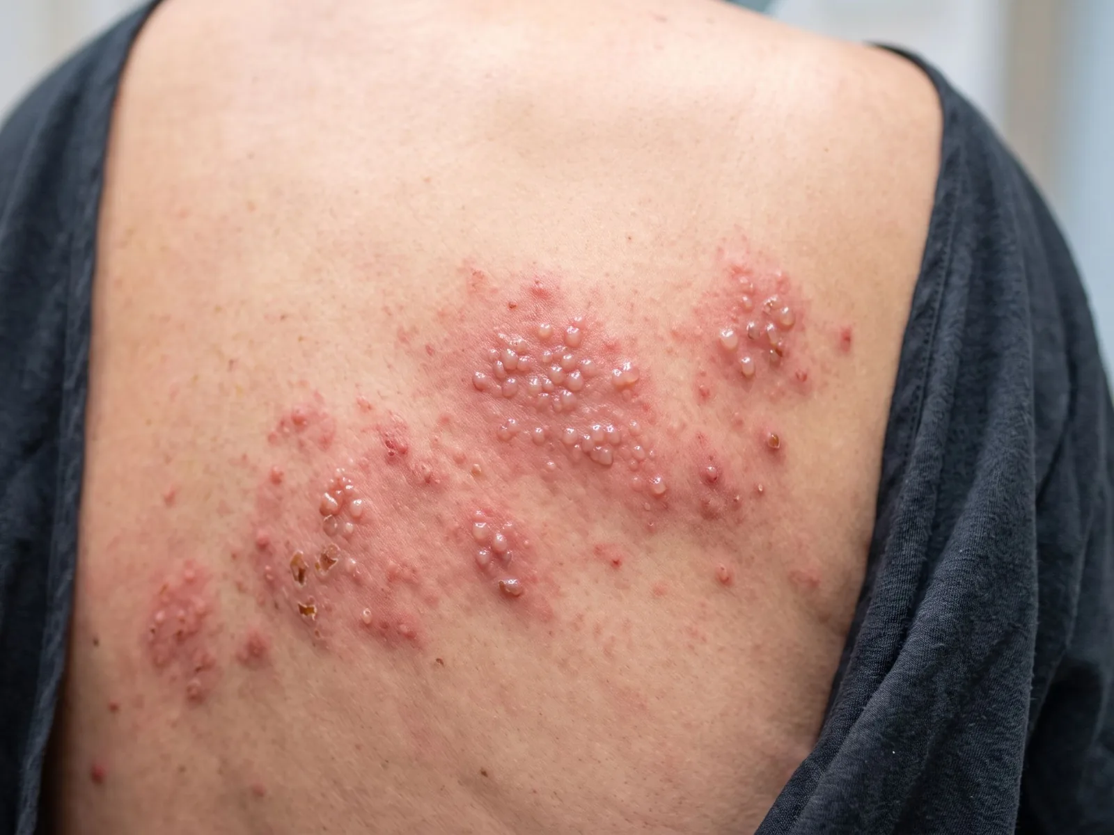 Herpes zoster: erupție dureroasă și consult dermatologic