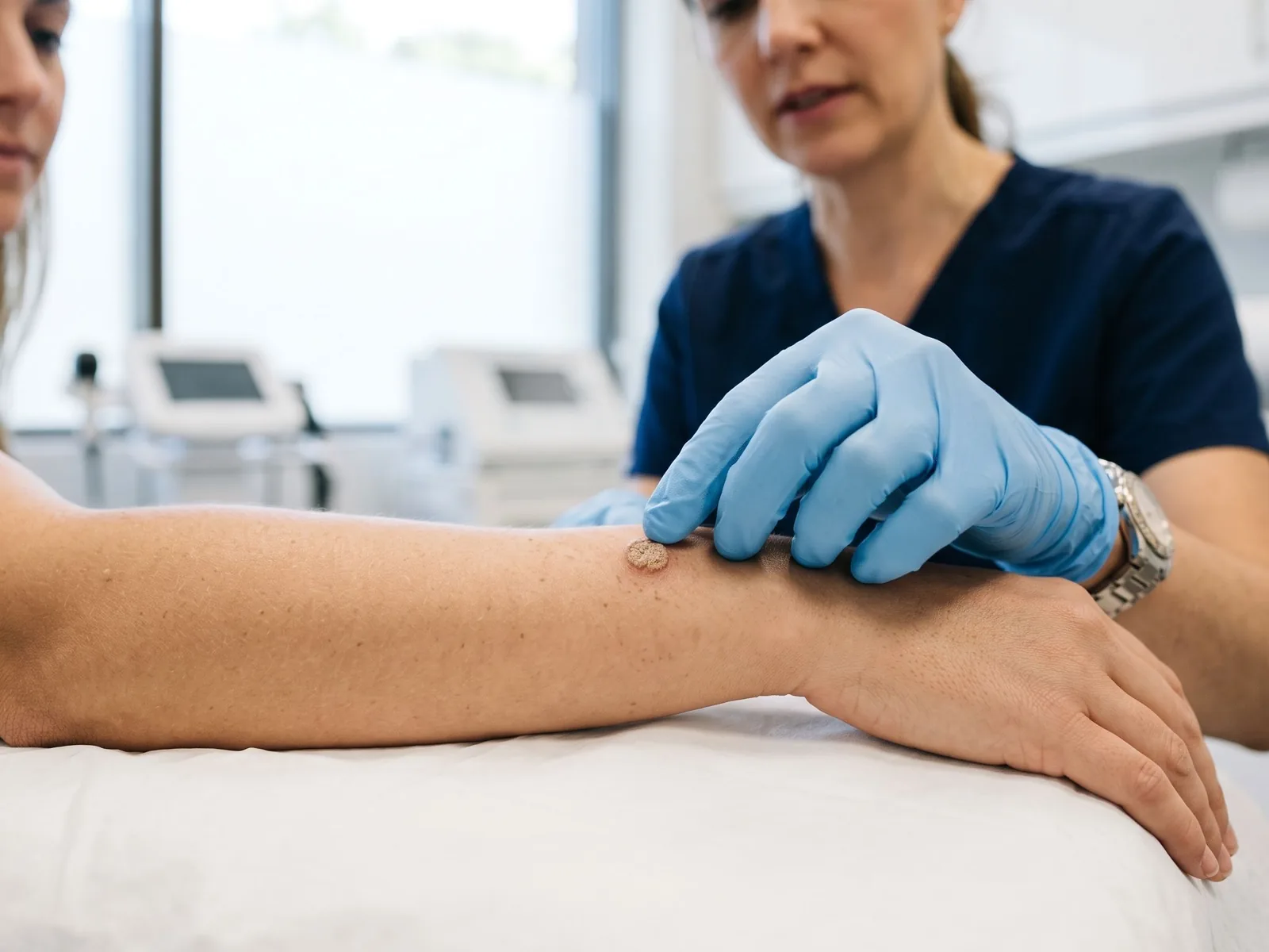 Negi și veruci: când mergi la dermatolog