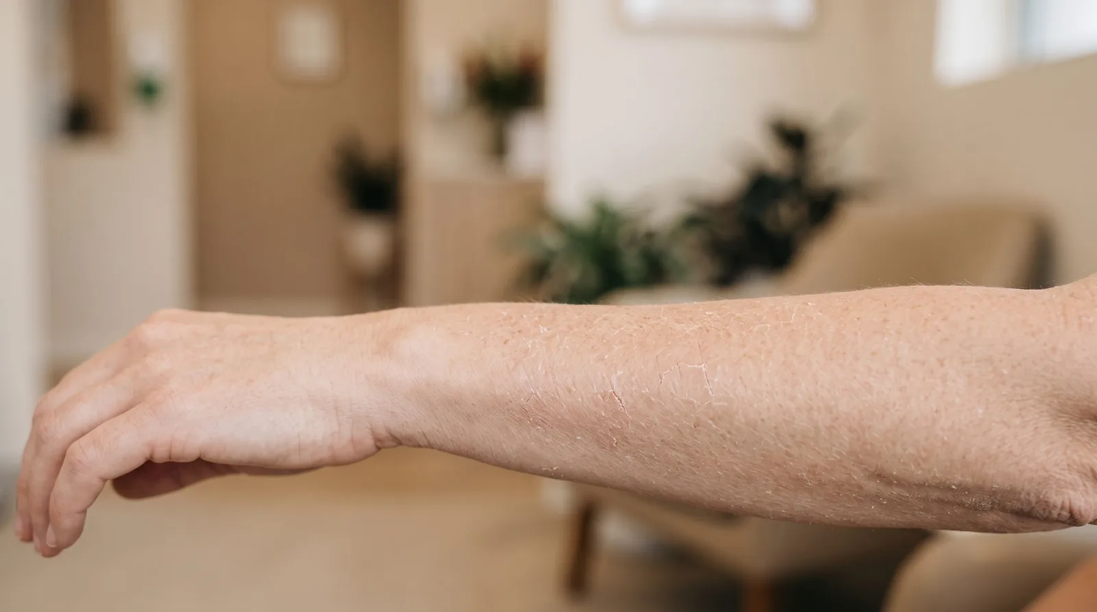 Piele uscată și descuamare: cauze și consult dermatologic