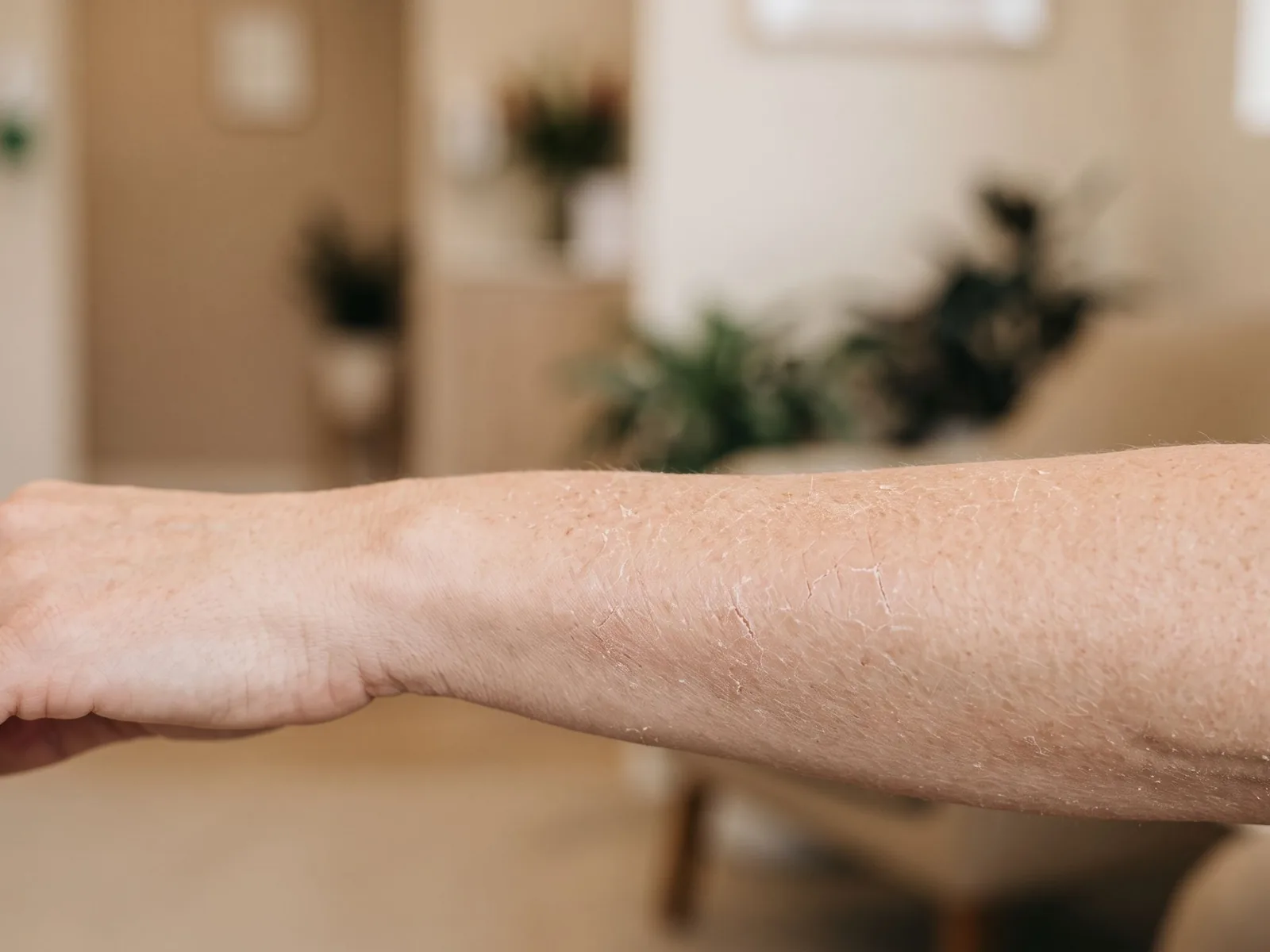 Piele uscată și descuamare: cauze și consult dermatologic